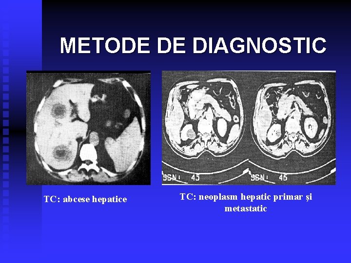 METODE DE DIAGNOSTIC TC: abcese hepatice TC: neoplasm hepatic primar şi metastatic 