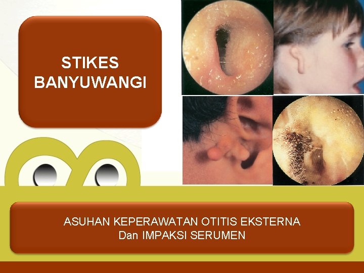 STIKES BANYUWANGI ASUHAN KEPERAWATAN OTITIS EKSTERNA Dan IMPAKSI SERUMEN 
