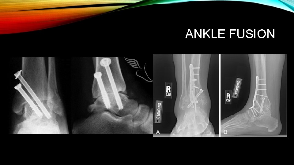 ANKLE FUSION 