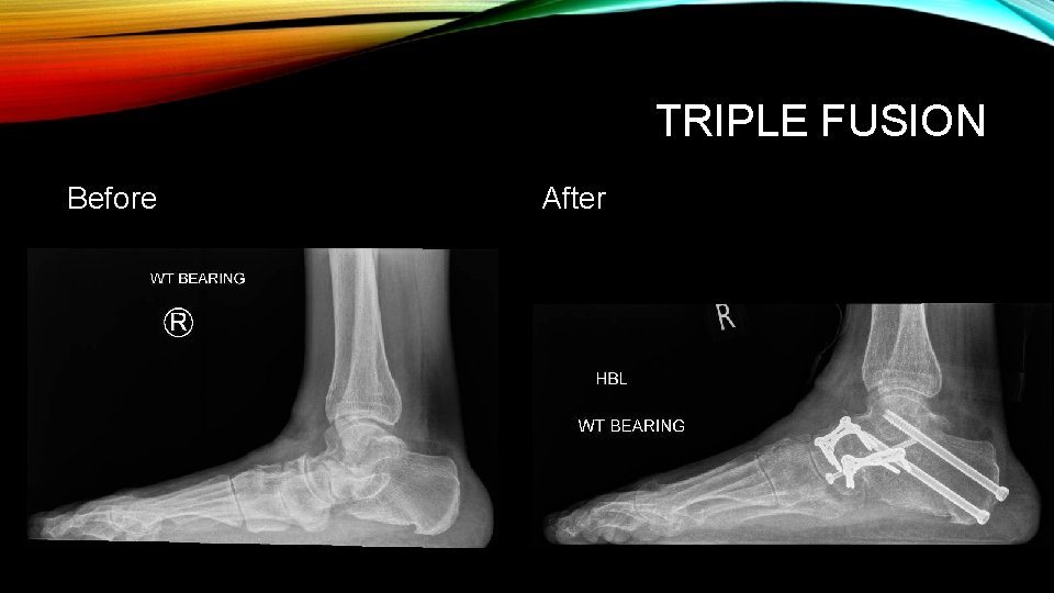 TRIPLE FUSION Before After 