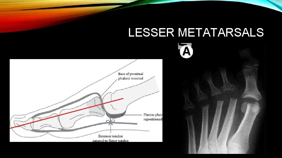 LESSER METATARSALS 