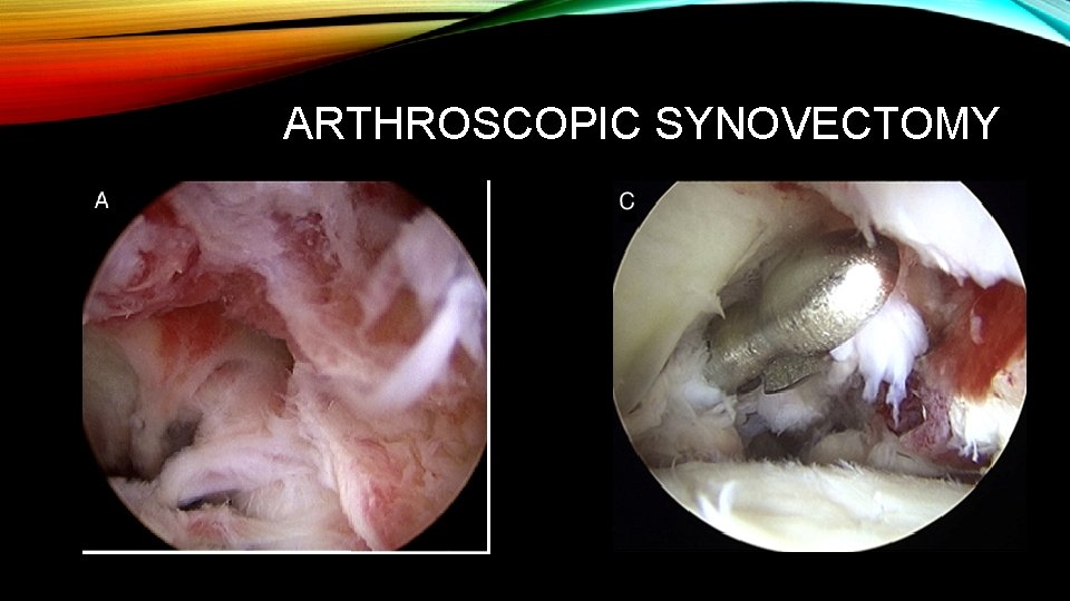 ARTHROSCOPIC SYNOVECTOMY 