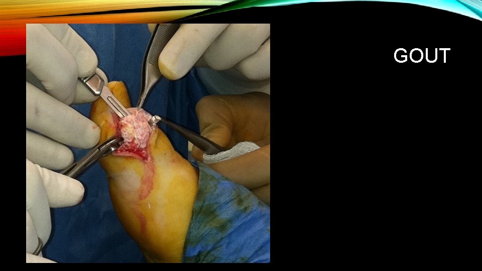 GOUT 