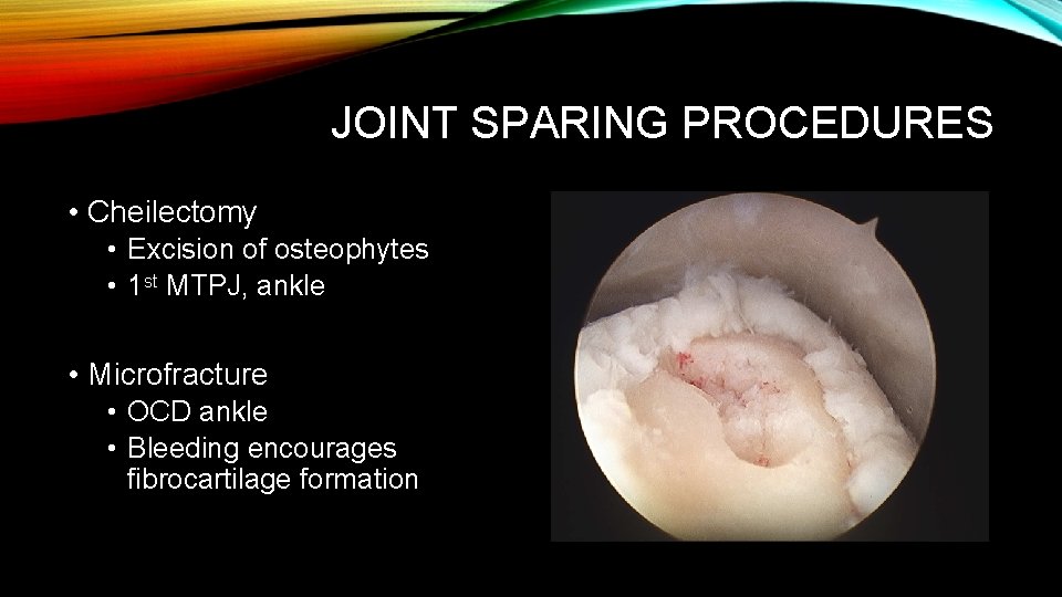 JOINT SPARING PROCEDURES • Cheilectomy • Excision of osteophytes • 1 st MTPJ, ankle