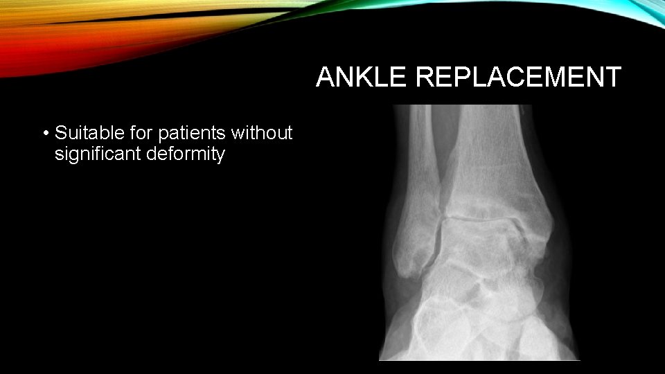 ANKLE REPLACEMENT • Suitable for patients without significant deformity 