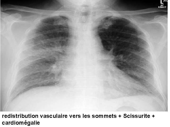 redistribution vasculaire vers les sommets + Scissurite + cardiomégalie 