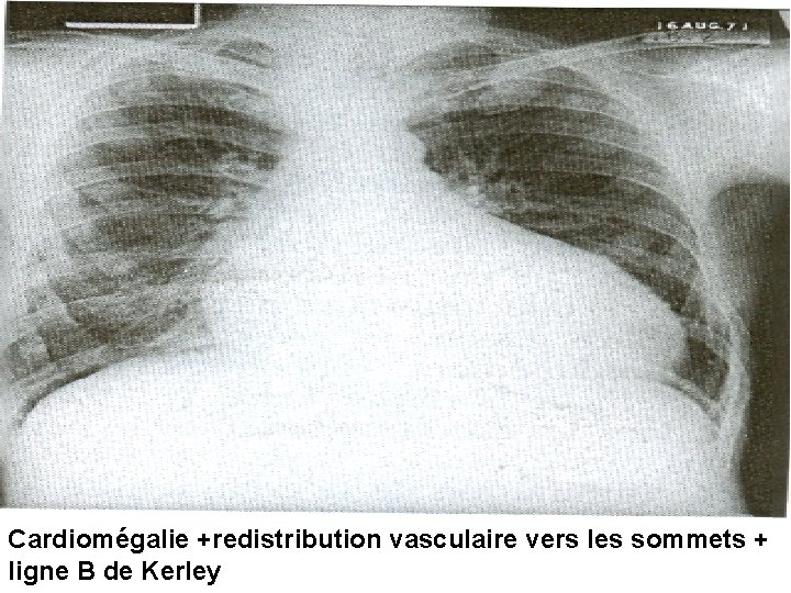 Cardiomégalie +redistribution vasculaire vers les sommets + ligne B de Kerley 