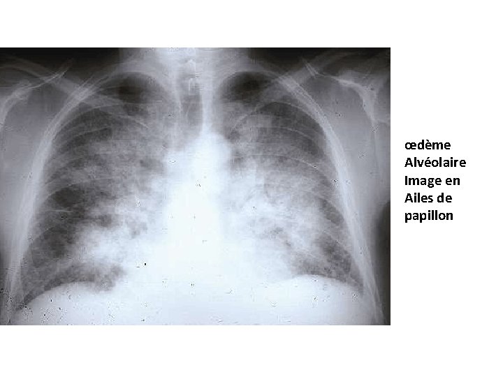 œdème Alvéolaire Image en Ailes de papillon 