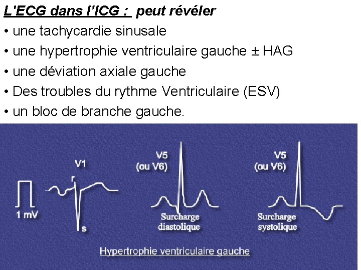 L'ECG dans l’ICG : peut révéler • une tachycardie sinusale • une hypertrophie ventriculaire