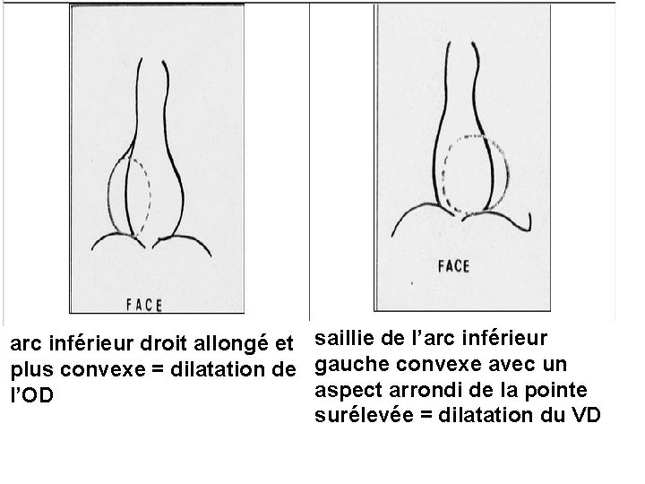 arc inférieur droit allongé et saillie de l’arc inférieur plus convexe = dilatation de