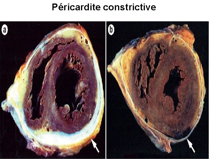Péricardite constrictive 