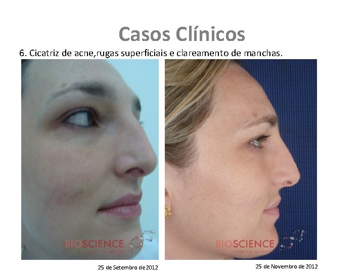 Casos Clínicos 6. Cicatriz de acne, rugas superficiais e clareamento de manchas. 25 de