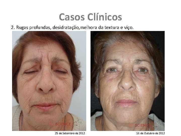 Casos Clínicos 2. Rugas profundas, desidratação, melhora da textura e viço. 25 de Setembro