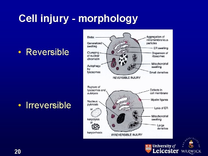 Cell injury - morphology • Reversible • Irreversible 20 