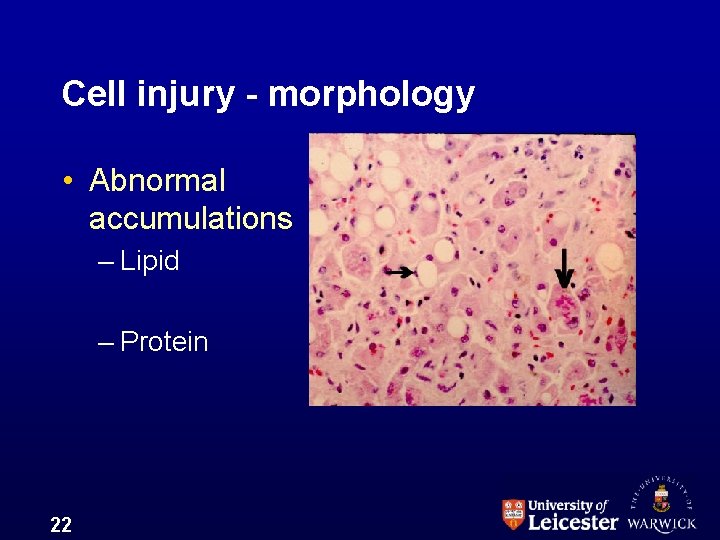 Cell injury - morphology • Abnormal accumulations – Lipid – Protein 22 