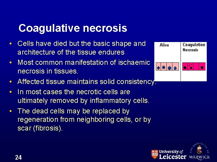 Coagulative necrosis • Cells have died but the basic shape and architecture of the