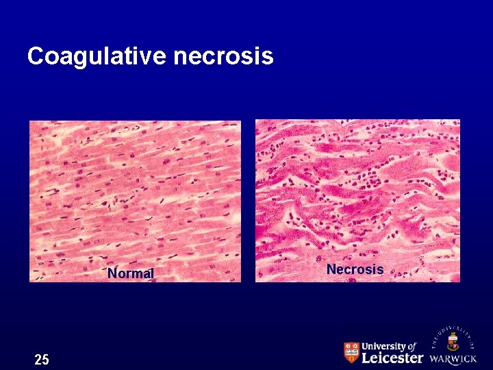 Coagulative necrosis Normal 25 Necrosis 