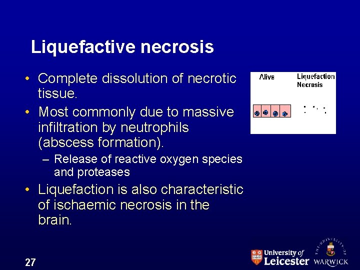 Liquefactive necrosis • Complete dissolution of necrotic tissue. • Most commonly due to massive