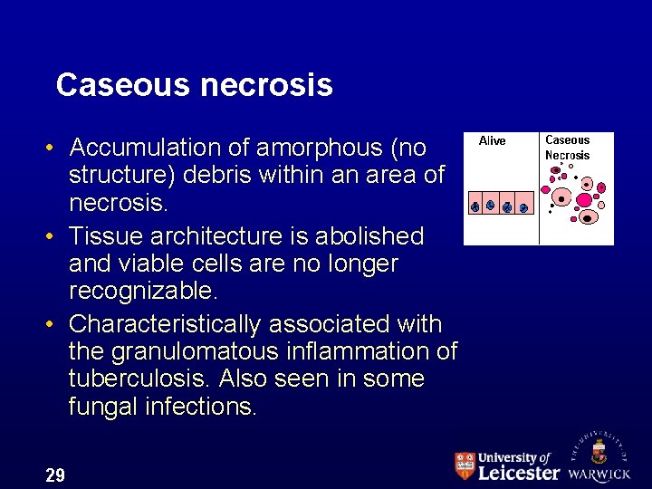 Caseous necrosis • Accumulation of amorphous (no structure) debris within an area of necrosis.