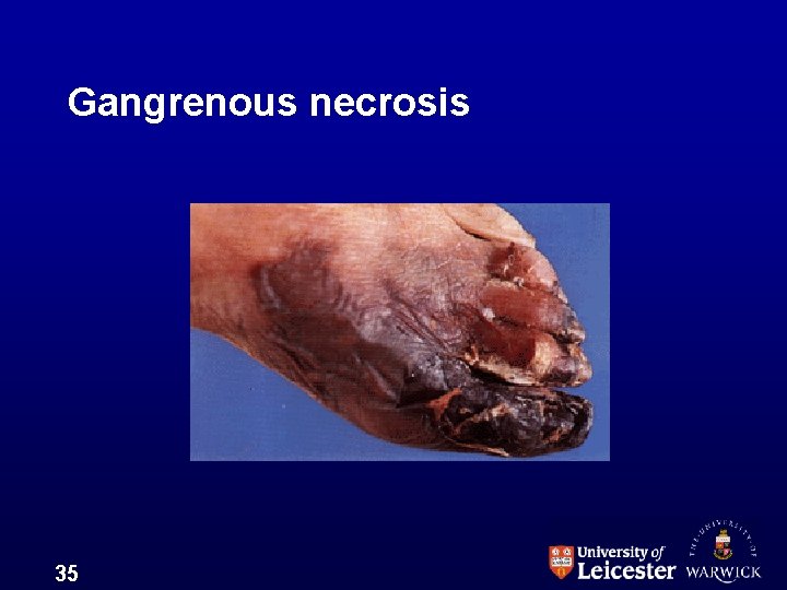 Gangrenous necrosis 35 