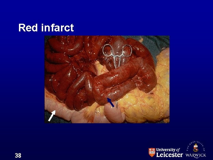Red infarct 38 