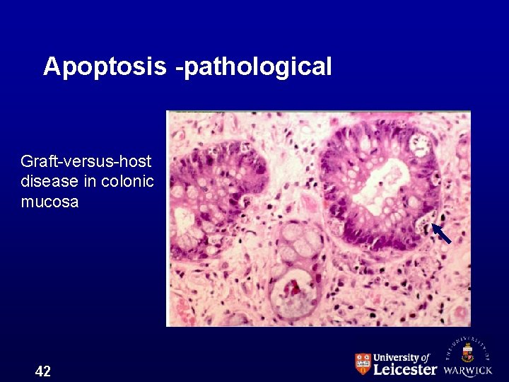 Apoptosis -pathological Graft-versus-host disease in colonic mucosa 42 