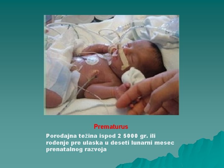 Prematurus Porođajna težina ispod 2 5000 gr. ili rođenje pre ulaska u deseti lunarni