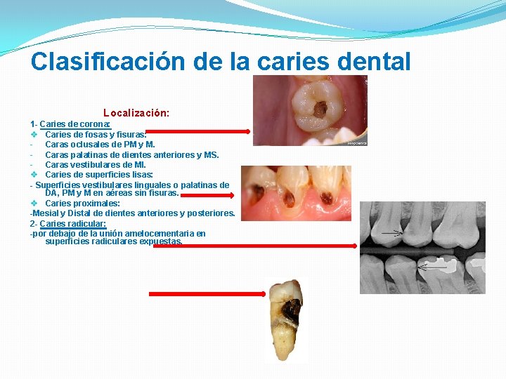 Clasificación de la caries dental Localización: 1 - Caries de corona: v Caries de