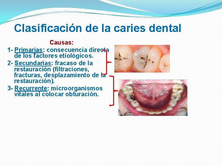Clasificación de la caries dental Causas: 1 - Primarias: consecuencia directa de los factores
