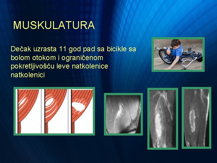 MUSKULATURA Dečak uzrasta 11 god pad sa bicikle sa bolom otokom i ograničenom pokretljivošću MUSKULATURA Dečak uzrasta 11 god pad sa bicikle sa bolom otokom i ograničenom pokretljivošću