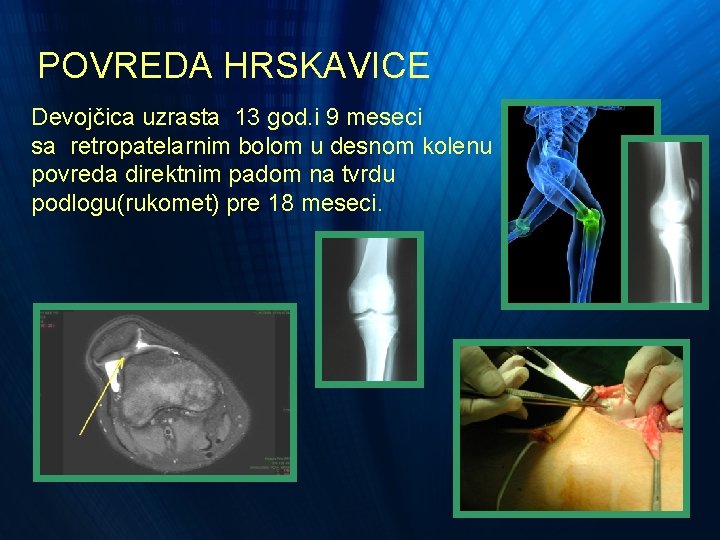 POVREDA HRSKAVICE Devojčica uzrasta 13 god. i 9 meseci sa retropatelarnim bolom u desnom POVREDA HRSKAVICE Devojčica uzrasta 13 god. i 9 meseci sa retropatelarnim bolom u desnom