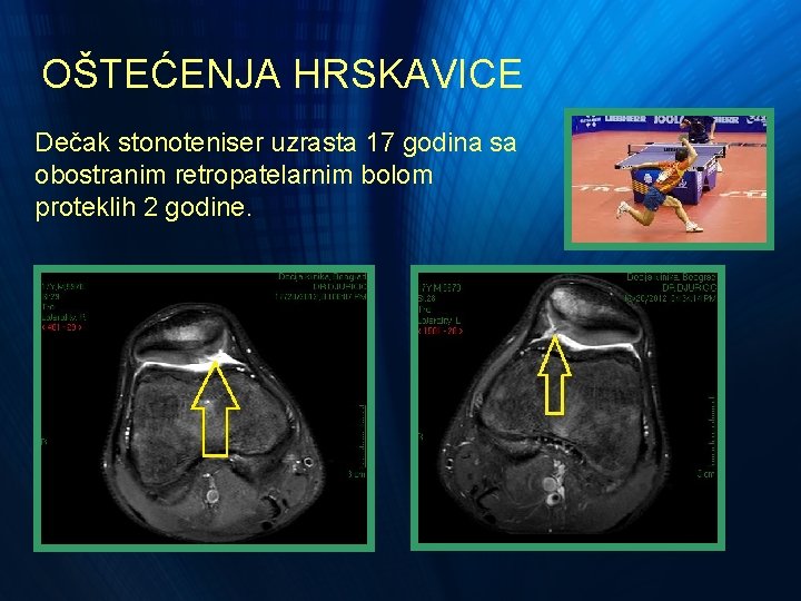 OŠTEĆENJA HRSKAVICE Dečak stonoteniser uzrasta 17 godina sa obostranim retropatelarnim bolom proteklih 2 godine. OŠTEĆENJA HRSKAVICE Dečak stonoteniser uzrasta 17 godina sa obostranim retropatelarnim bolom proteklih 2 godine.