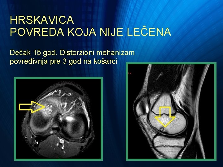 HRSKAVICA POVREDA KOJA NIJE LEČENA Dečak 15 god. Distorzioni mehanizam povređivnja pre 3 god HRSKAVICA POVREDA KOJA NIJE LEČENA Dečak 15 god. Distorzioni mehanizam povređivnja pre 3 god