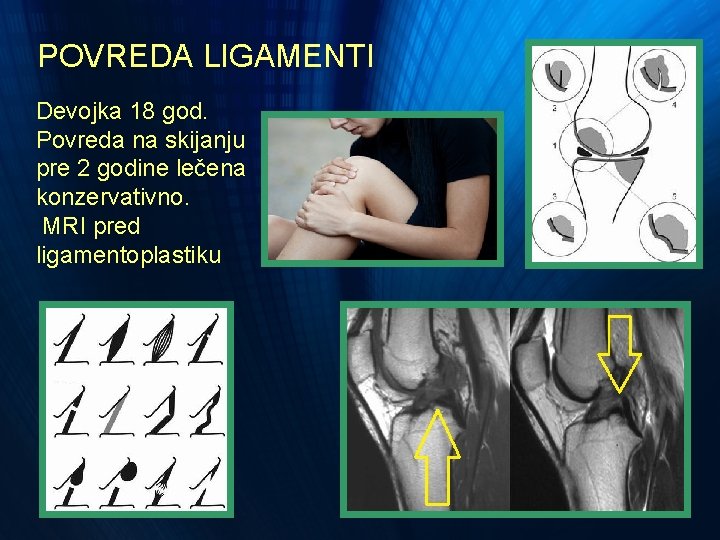 POVREDA LIGAMENTI Devojka 18 god. Povreda na skijanju pre 2 godine lečena konzervativno. MRI POVREDA LIGAMENTI Devojka 18 god. Povreda na skijanju pre 2 godine lečena konzervativno. MRI