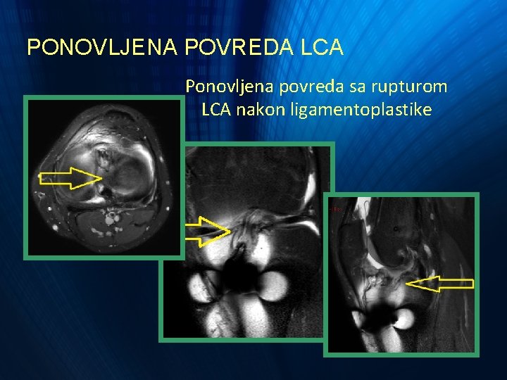 PONOVLJENA POVREDA LCA Ponovljena povreda sa rupturom LCA nakon ligamentoplastike PONOVLJENA POVREDA LCA Ponovljena povreda sa rupturom LCA nakon ligamentoplastike