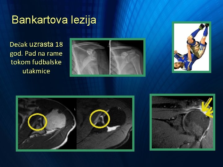 Bankartova lezija Dečak uzrasta 18 god. Pad na rame tokom fudbalske utakmice Bankartova lezija Dečak uzrasta 18 god. Pad na rame tokom fudbalske utakmice