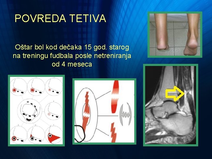 POVREDA TETIVA Oštar bol kod dečaka 15 god. starog na treningu fudbala posle netreniranja POVREDA TETIVA Oštar bol kod dečaka 15 god. starog na treningu fudbala posle netreniranja