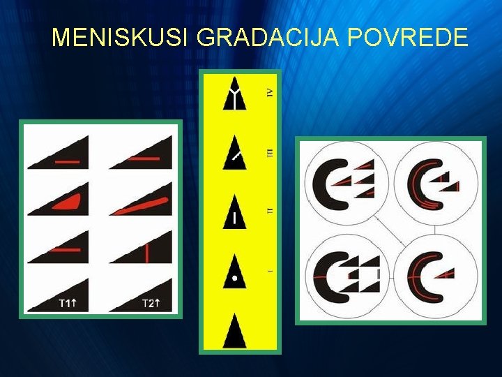 MENISKUSI GRADACIJA POVREDE MENISKUSI GRADACIJA POVREDE