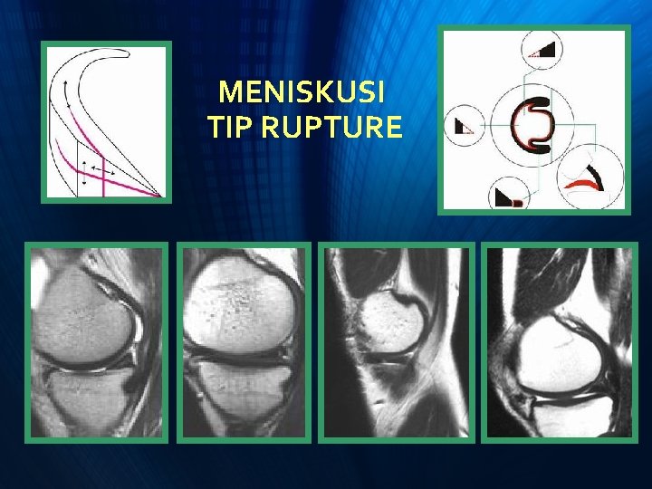 MENISKUSI TIP RUPTURE MENISKUSI TIP RUPTURE