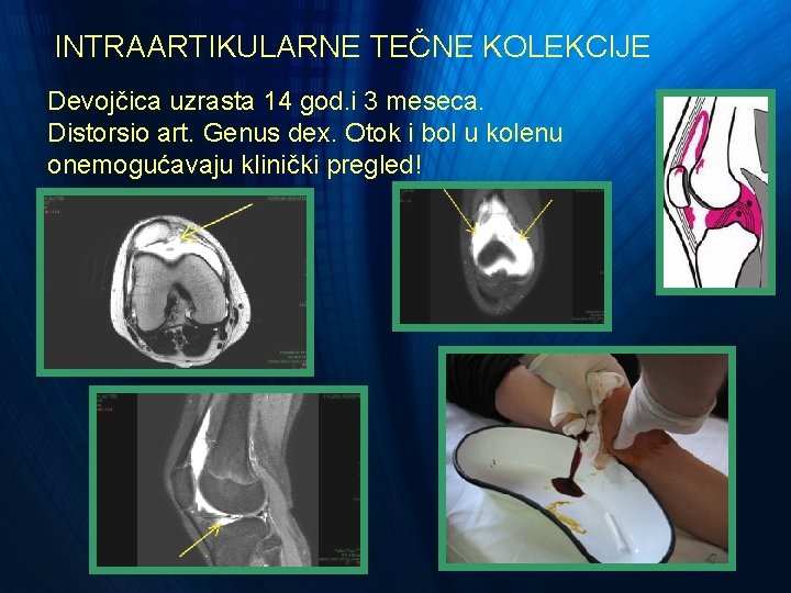INTRAARTIKULARNE TEČNE KOLEKCIJE Devojčica uzrasta 14 god. i 3 meseca. Distorsio art. Genus dex. INTRAARTIKULARNE TEČNE KOLEKCIJE Devojčica uzrasta 14 god. i 3 meseca. Distorsio art. Genus dex.