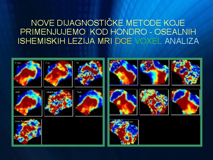 NOVE DIJAGNOSTIČKE METODE KOJE PRIMENJUJEMO KOD HONDRO - OSEALNIH ISHEMISKIH LEZIJA MRI DCE VOXEL NOVE DIJAGNOSTIČKE METODE KOJE PRIMENJUJEMO KOD HONDRO - OSEALNIH ISHEMISKIH LEZIJA MRI DCE VOXEL