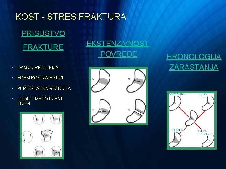 KOST - STRES FRAKTURA PRISUSTVO FRAKTURE • FRAKTURNA LINIJA • EDEM KOŠTANE SRŽI • KOST - STRES FRAKTURA PRISUSTVO FRAKTURE • FRAKTURNA LINIJA • EDEM KOŠTANE SRŽI •