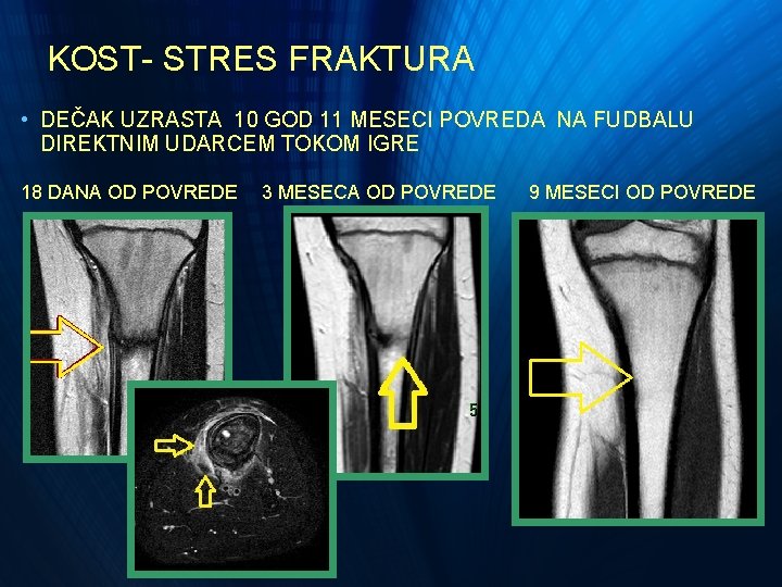 KOST- STRES FRAKTURA • DEČAK UZRASTA 10 GOD 11 MESECI POVREDA NA FUDBALU DIREKTNIM KOST- STRES FRAKTURA • DEČAK UZRASTA 10 GOD 11 MESECI POVREDA NA FUDBALU DIREKTNIM