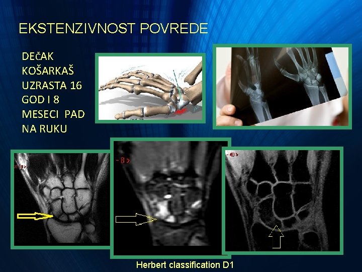 EKSTENZIVNOST POVREDE DEČAK KOŠARKAŠ UZRASTA 16 GOD I 8 MESECI PAD NA RUKU Herbert EKSTENZIVNOST POVREDE DEČAK KOŠARKAŠ UZRASTA 16 GOD I 8 MESECI PAD NA RUKU Herbert