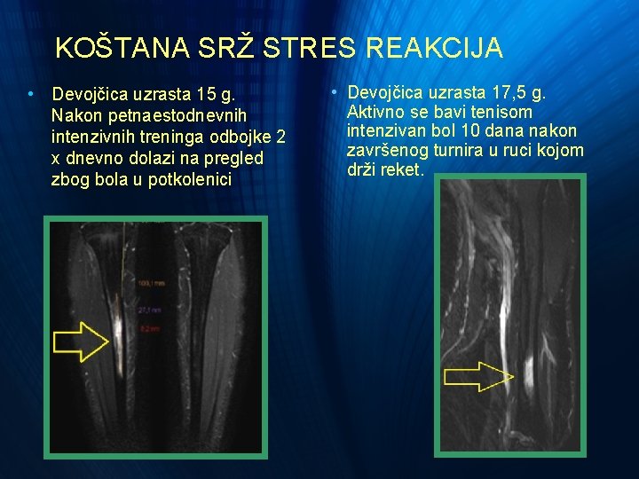 KOŠTANA SRŽ STRES REAKCIJA • Devojčica uzrasta 15 g. Nakon petnaestodnevnih intenzivnih treninga odbojke KOŠTANA SRŽ STRES REAKCIJA • Devojčica uzrasta 15 g. Nakon petnaestodnevnih intenzivnih treninga odbojke
