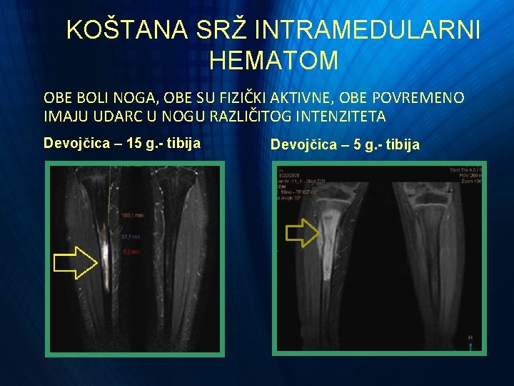 KOŠTANA SRŽ INTRAMEDULARNI HEMATOM OBE BOLI NOGA, OBE SU FIZIČKI AKTIVNE, OBE POVREMENO IMAJU KOŠTANA SRŽ INTRAMEDULARNI HEMATOM OBE BOLI NOGA, OBE SU FIZIČKI AKTIVNE, OBE POVREMENO IMAJU