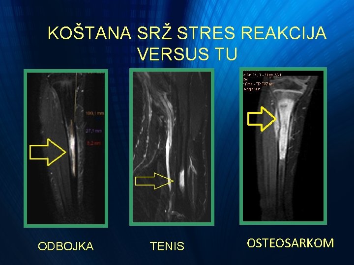 KOŠTANA SRŽ STRES REAKCIJA VERSUS TU ODBOJKA TENIS OSTEOSARKOM KOŠTANA SRŽ STRES REAKCIJA VERSUS TU ODBOJKA TENIS OSTEOSARKOM
