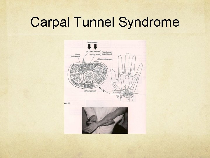 Carpal Tunnel Syndrome 