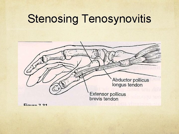 Stenosing Tenosynovitis 