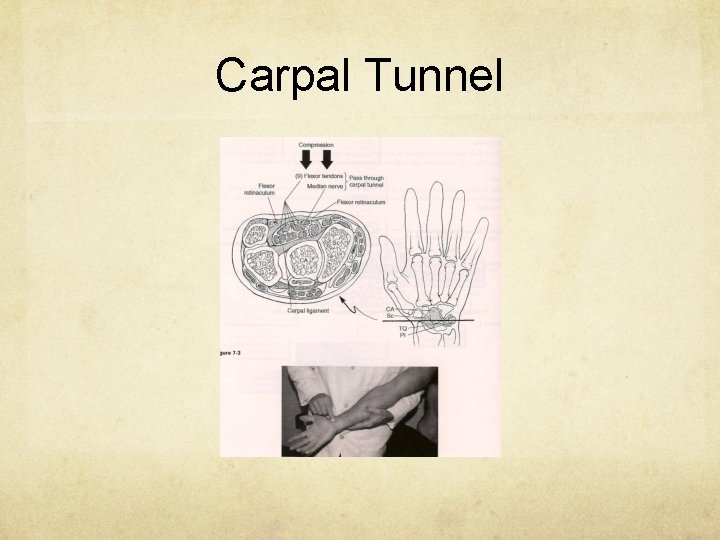 Carpal Tunnel 